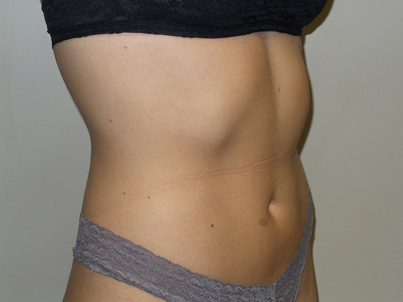 Emsculpt Before and After 03 | Grover Aesthetics