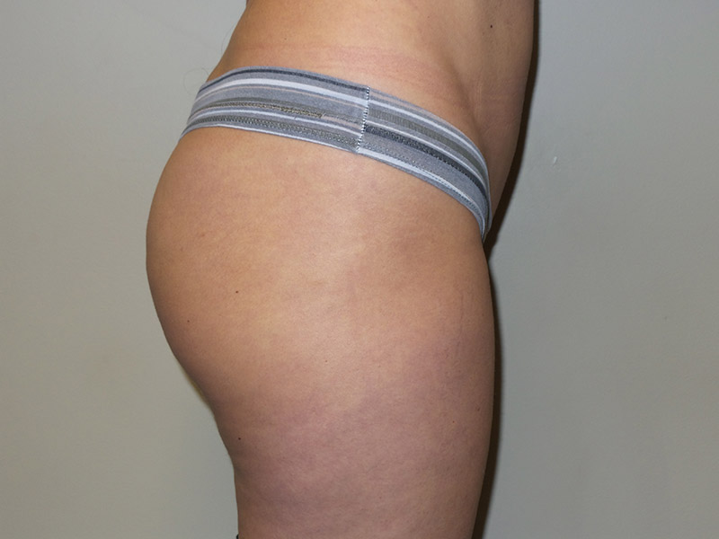 Emsculpt Before and After | Grover Aesthetics