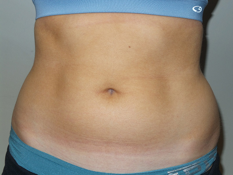 Emsculpt Before and After | Grover Aesthetics