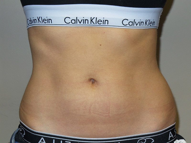 Emsculpt Before and After | Grover Aesthetics