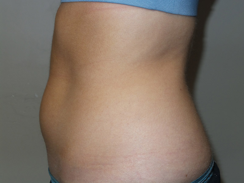 Emsculpt Before and After 05 | Grover Aesthetics
