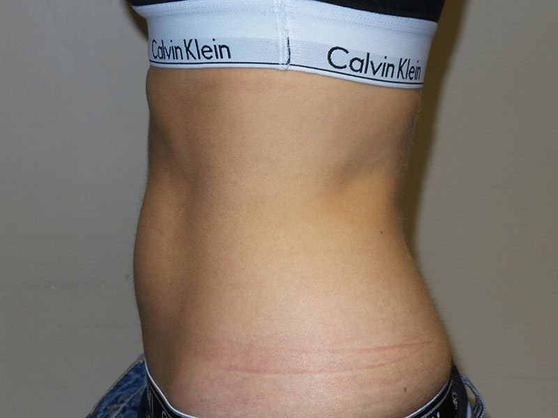 Emsculpt Before and After 05 | Grover Aesthetics