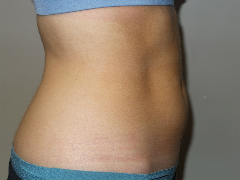 Emsculpt Before and After 05 | Grover Aesthetics