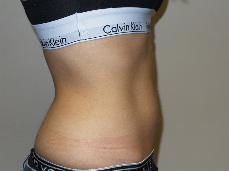 Emsculpt Before and After 05 | Grover Aesthetics