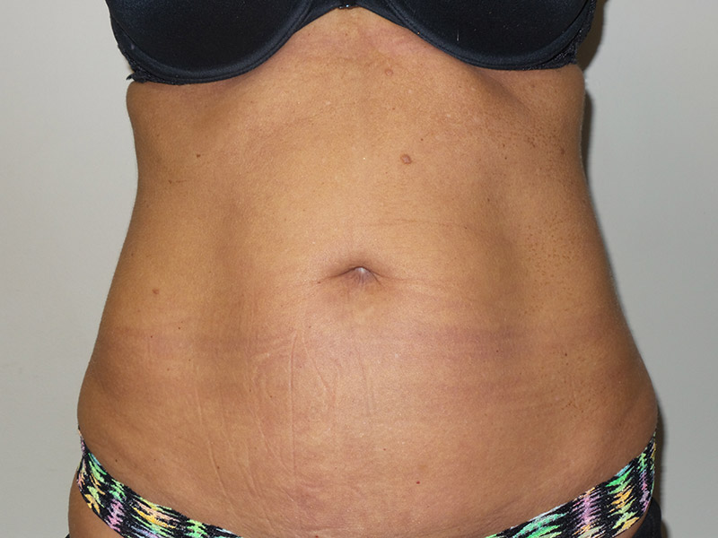 Emsculpt Before and After | Grover Aesthetics