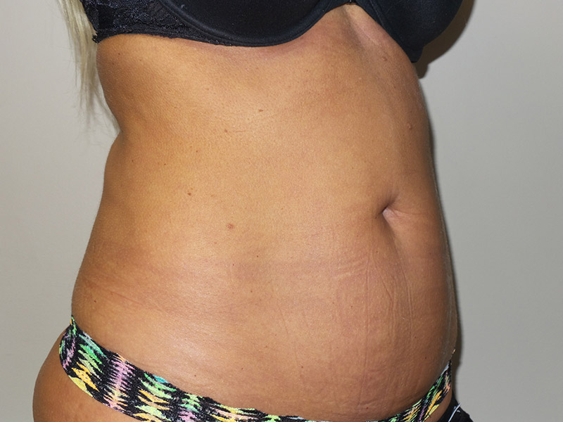 Emsculpt Before and After 06 | Grover Aesthetics