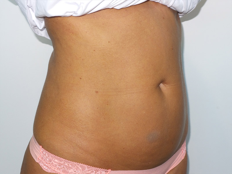 Emsculpt Before and After 06 | Grover Aesthetics