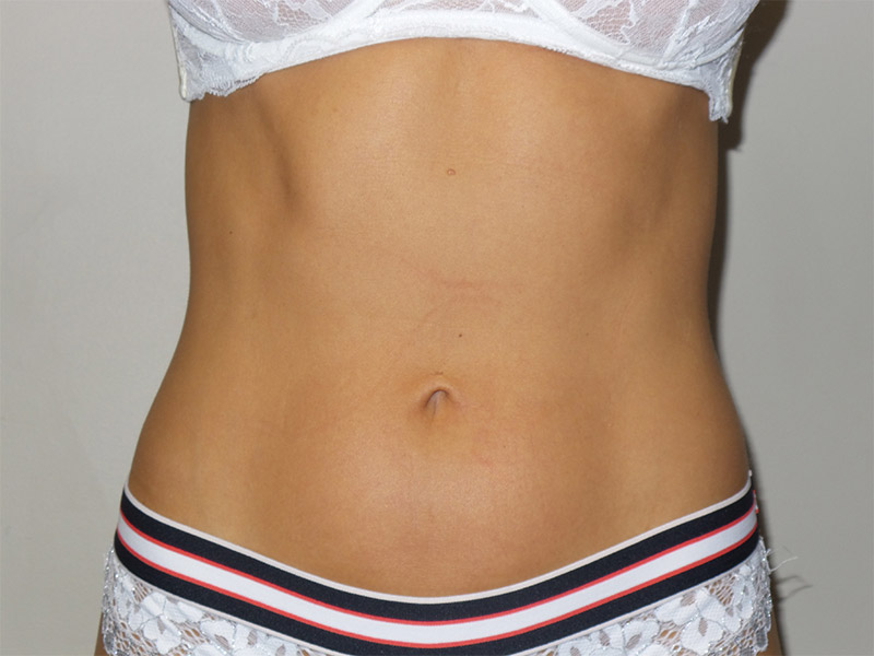 Emsculpt Before and After | Grover Aesthetics