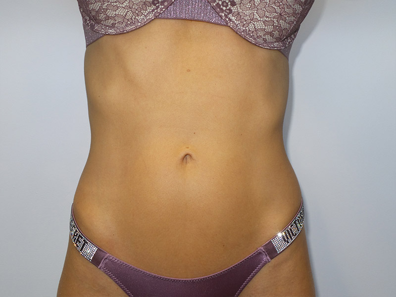 Emsculpt Before and After | Grover Aesthetics