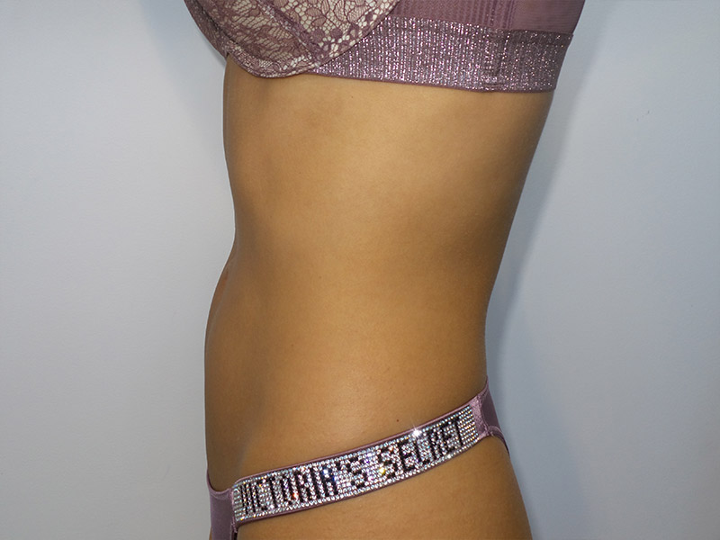 Emsculpt Before and After 08 | Grover Aesthetics