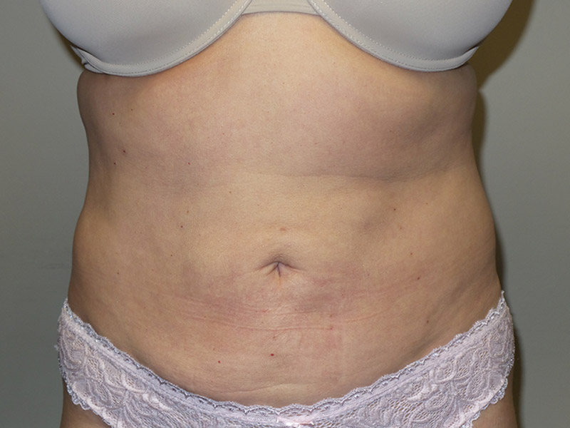 Exilis Before and After | Grover Aesthetics
