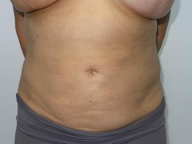 Exilis Before and After | Grover Aesthetics