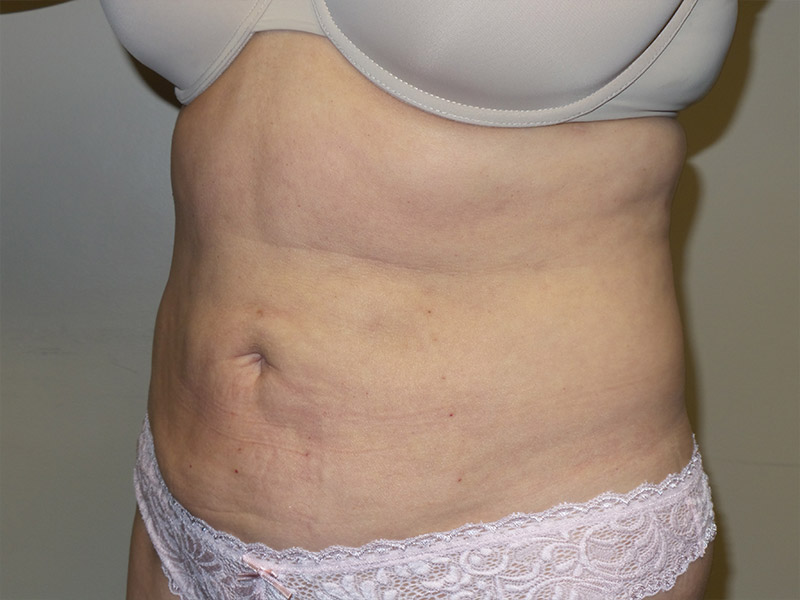 Exilis Before and After 01 | Grover Aesthetics