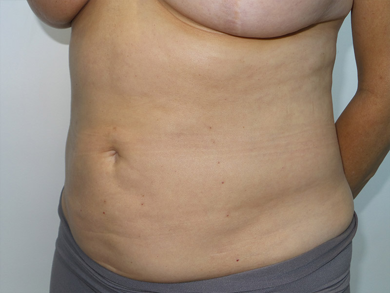 Exilis Before and After 01 | Grover Aesthetics