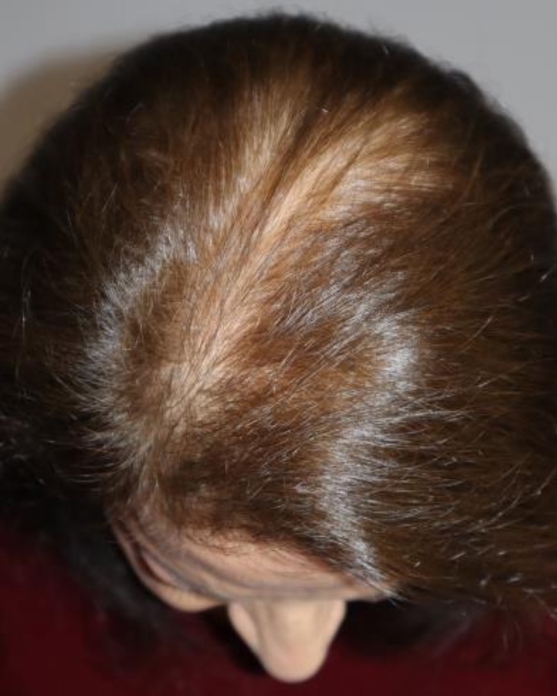 Folix Laser Before and After | Grover Aesthetics
