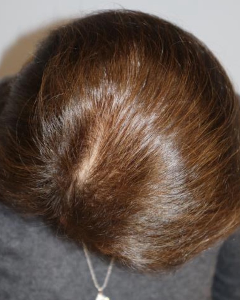 Folix Laser Before and After | Grover Aesthetics