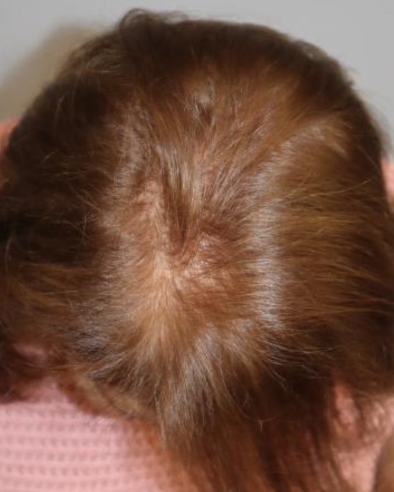 Folix Laser Before and After | Grover Aesthetics