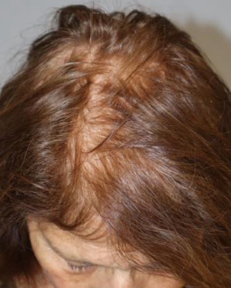 Folix Laser Before and After | Grover Aesthetics