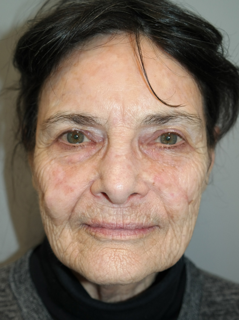 G Peel Before and After | Grover Aesthetics