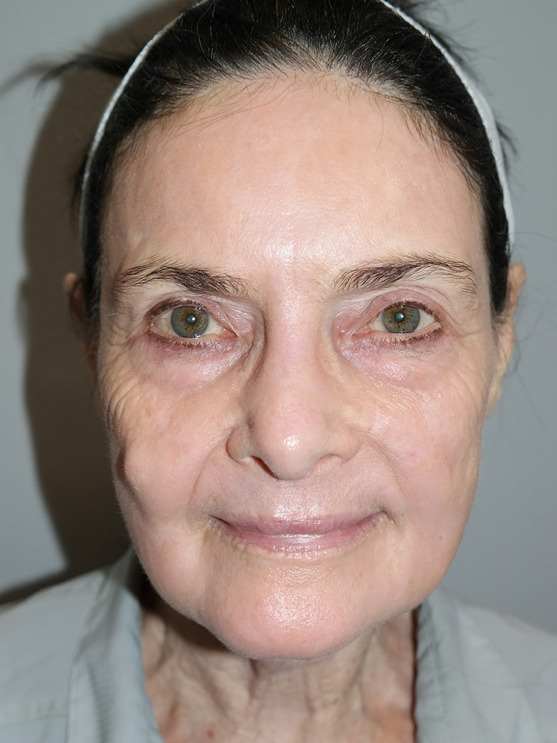 G Peel Before and After | Grover Aesthetics