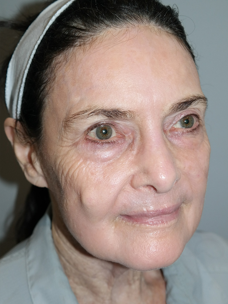 G Peel Before and After 01 | Grover Aesthetics