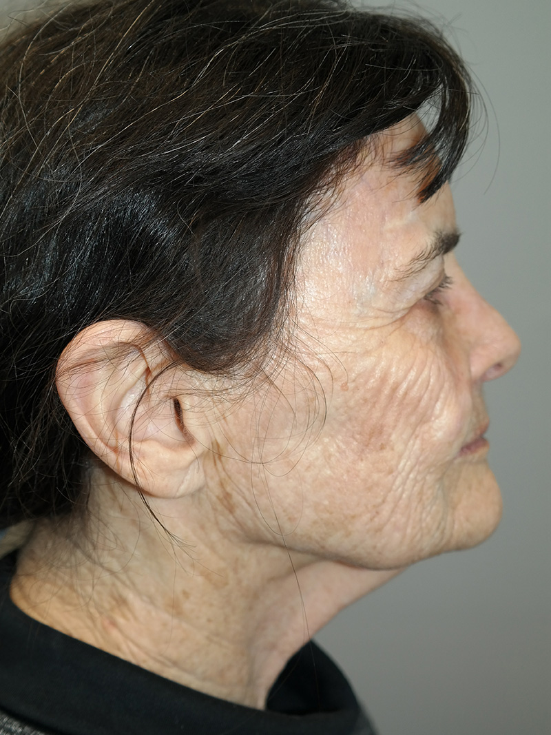 G Peel Before and After 01 | Grover Aesthetics