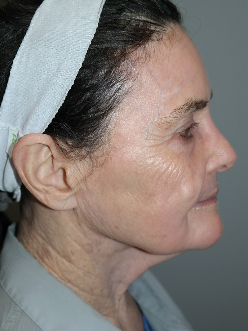 G Peel Before and After 01 | Grover Aesthetics