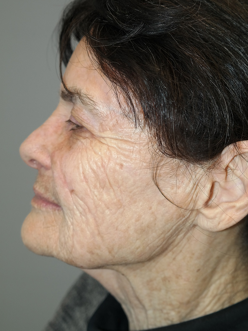 G Peel Before and After 01 | Grover Aesthetics