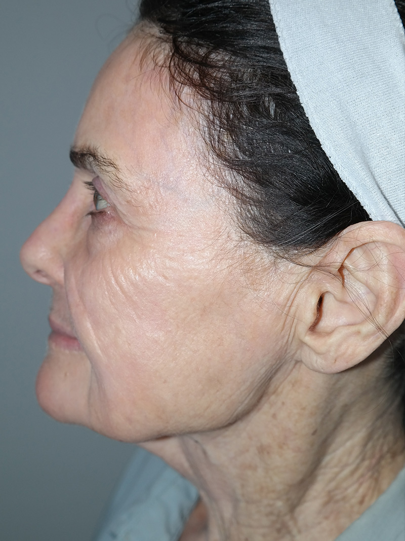 G Peel Before and After 01 | Grover Aesthetics