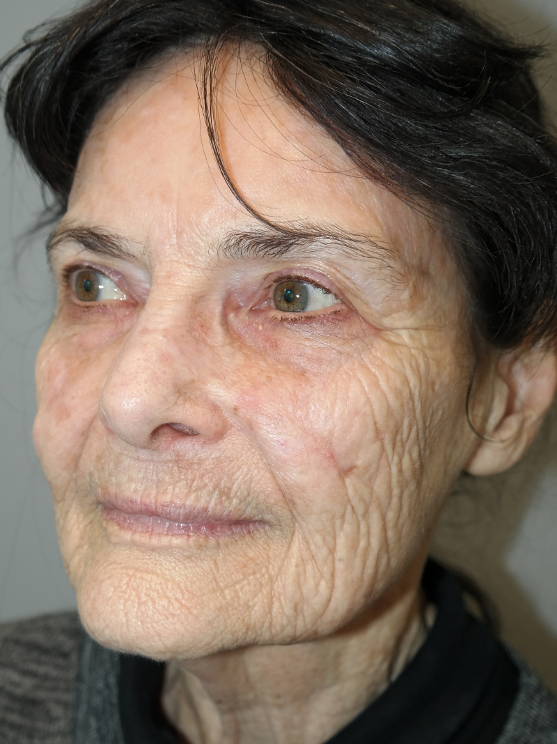 G Peel Before and After | Grover Aesthetics