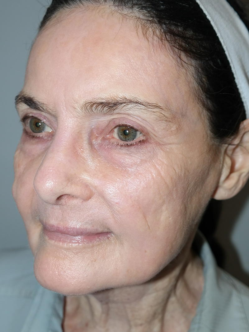 G Peel Before and After | Grover Aesthetics