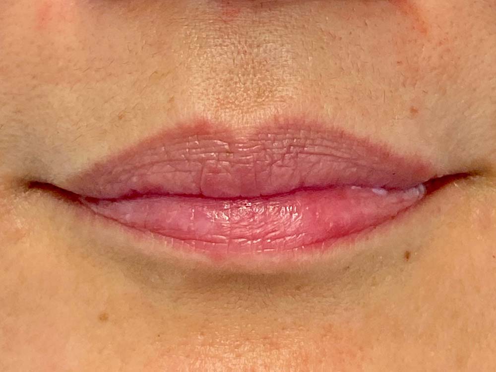 Injectables Before and After | Grover Aesthetics