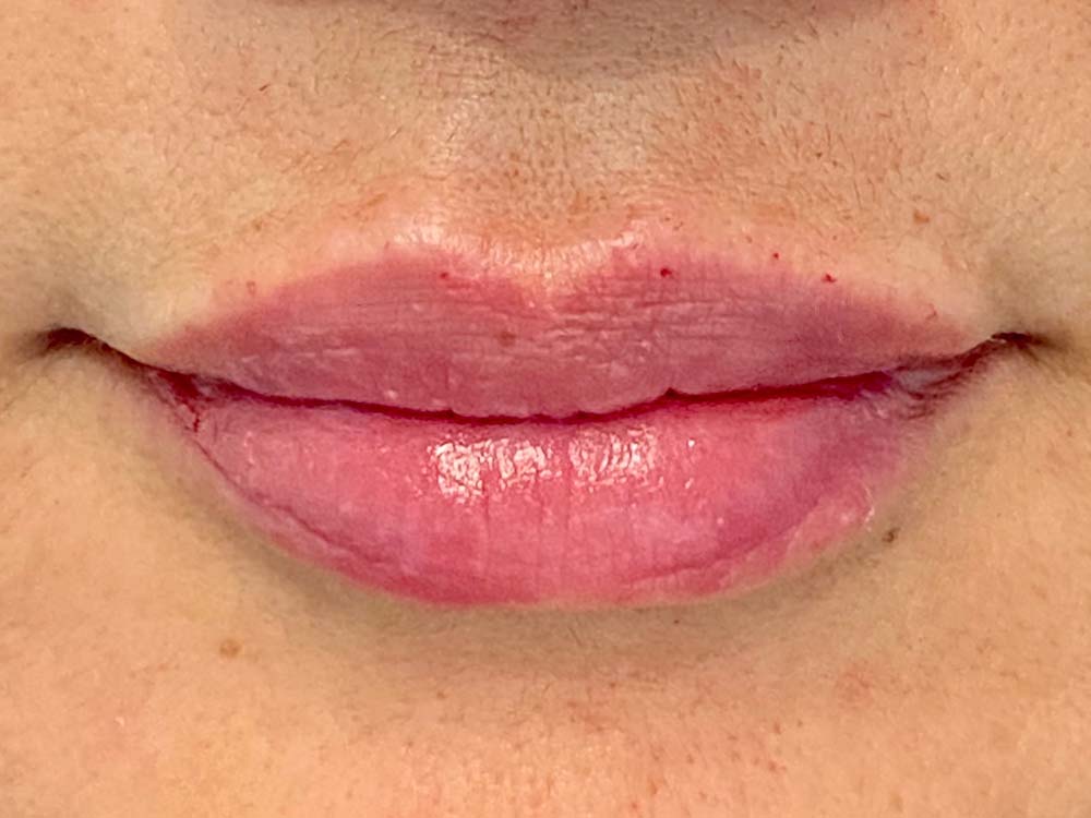 Injectables Before and After | Grover Aesthetics
