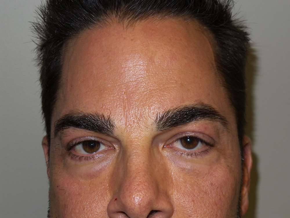 Injectables Before and After | Grover Aesthetics