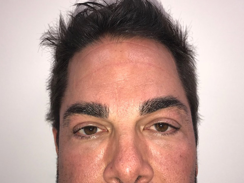 Injectables Before and After | Grover Aesthetics
