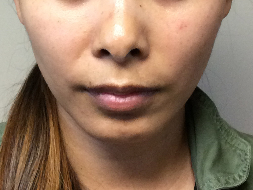 Injectables Before and After | Grover Aesthetics