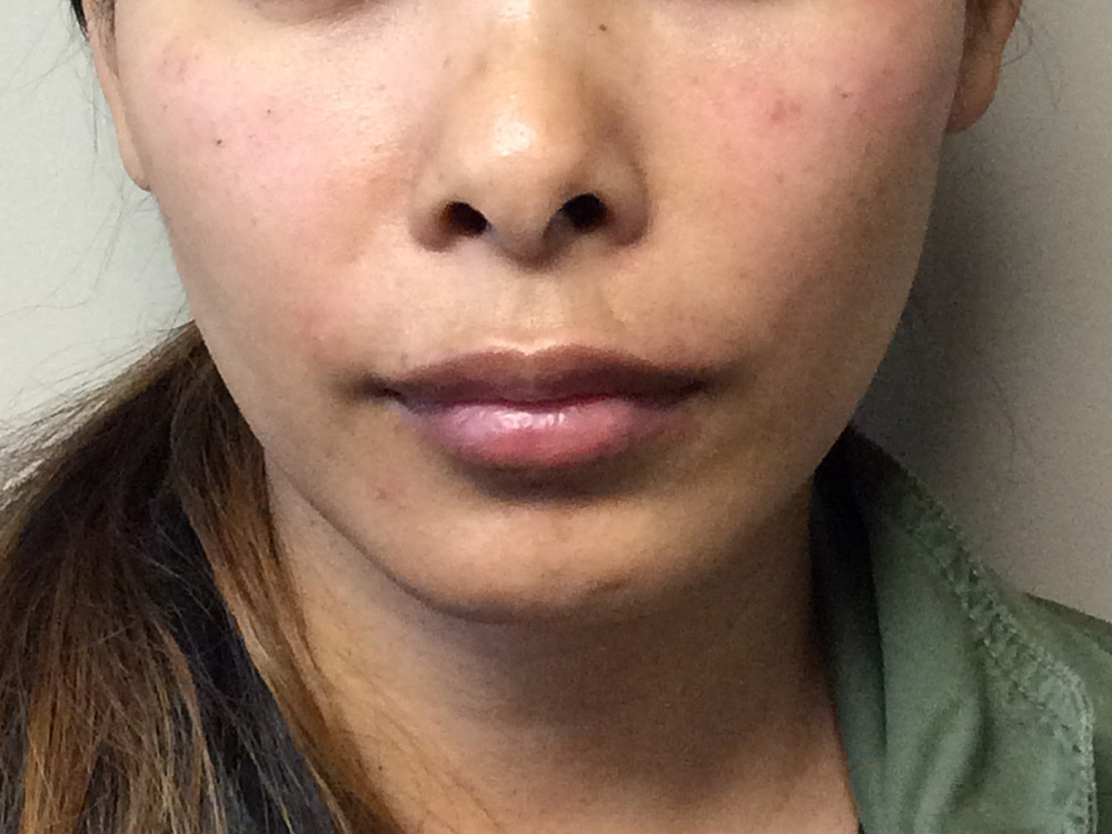Injectables Before and After | Grover Aesthetics