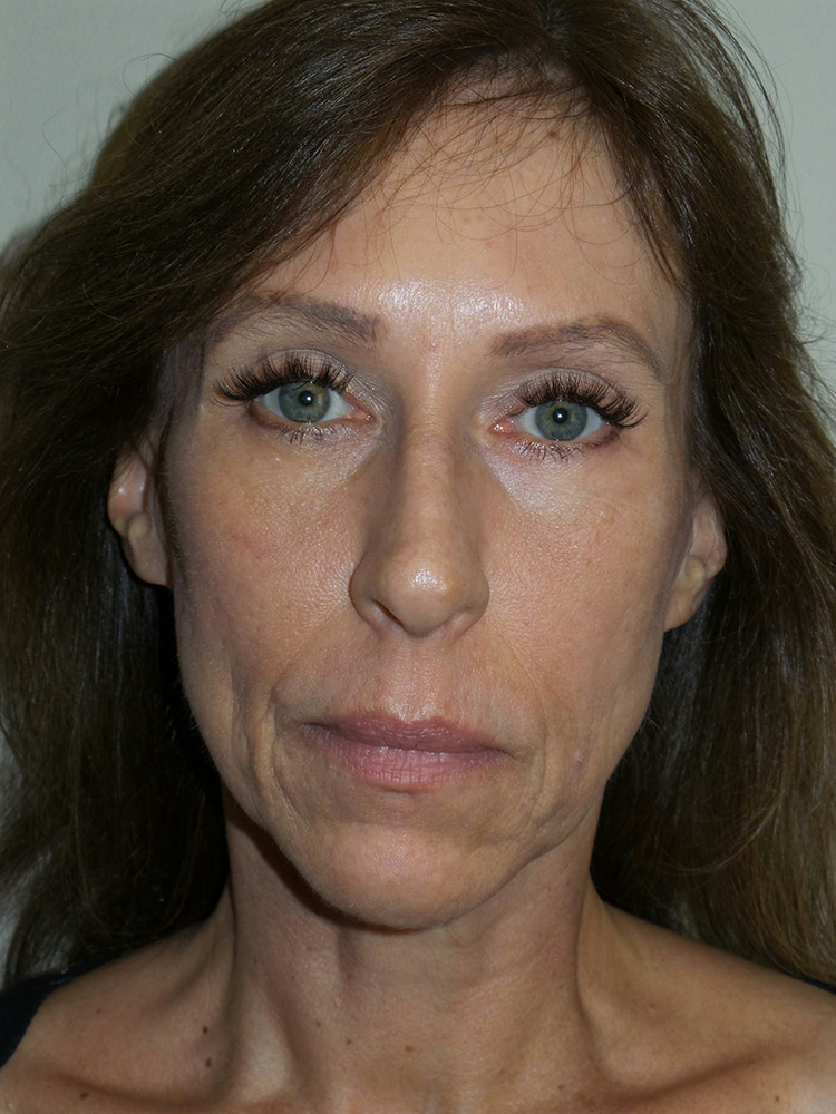 Injectables Before and After | Grover Aesthetics