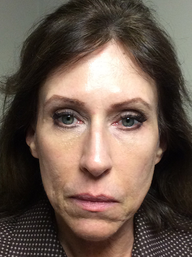 Injectables Before and After | Grover Aesthetics