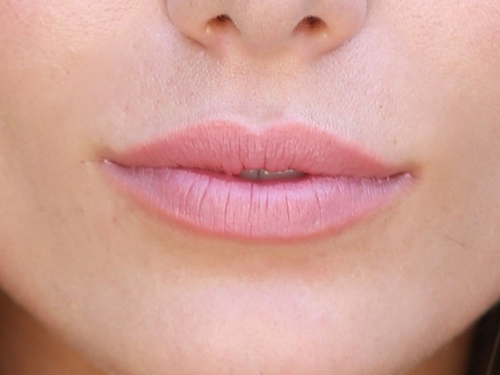 Injectables Before and After | Grover Aesthetics