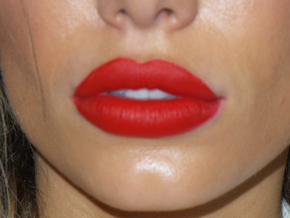 Injectables Before and After | Grover Aesthetics