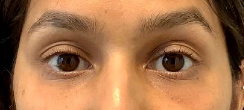 Injectables Before and After | Grover Aesthetics