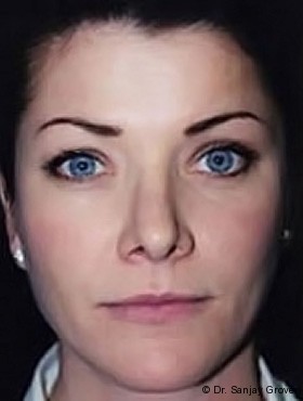 Juvederm Before and After | Grover Aesthetics
