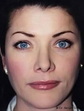 Juvederm Before and After | Grover Aesthetics