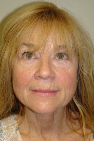 Laser Resurfacing Before and After | Grover Aesthetics