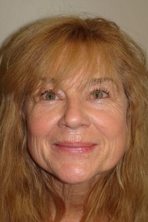 Laser Resurfacing Before and After | Grover Aesthetics