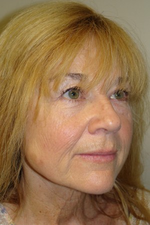 Laser Resurfacing Before and After 01 | Grover Aesthetics