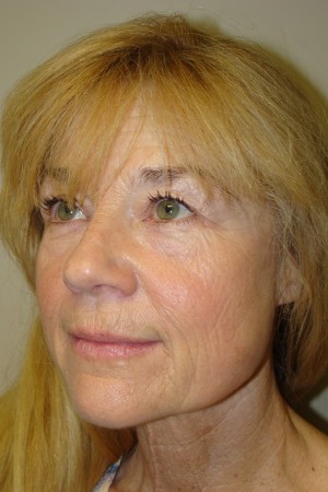Laser Resurfacing Before and After 01 | Grover Aesthetics