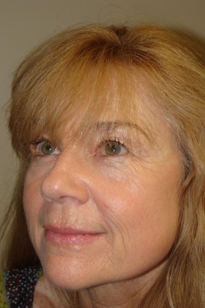 Laser Resurfacing Before and After 01 | Grover Aesthetics