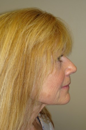 Laser Resurfacing Before and After 01 | Grover Aesthetics